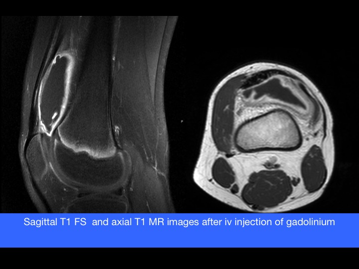 Figure 3 for case Symptomatic complete type of suprapatellar plica of the knee